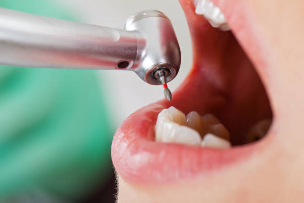 Best Walk-In Emergency Dentist in University Place, WA